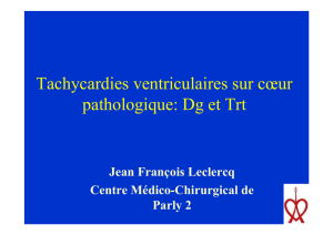 Tachycardies ventriculaires sur cœur pathologique: Dg et Trt