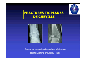 Fractures triplanes cheville