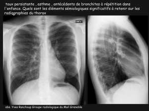 LM CC thorax syndrome de MacLeod