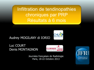 Infiltration de tendinopathies chroniques par PRP Résultats à 6 mois