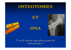 Ostéotomies