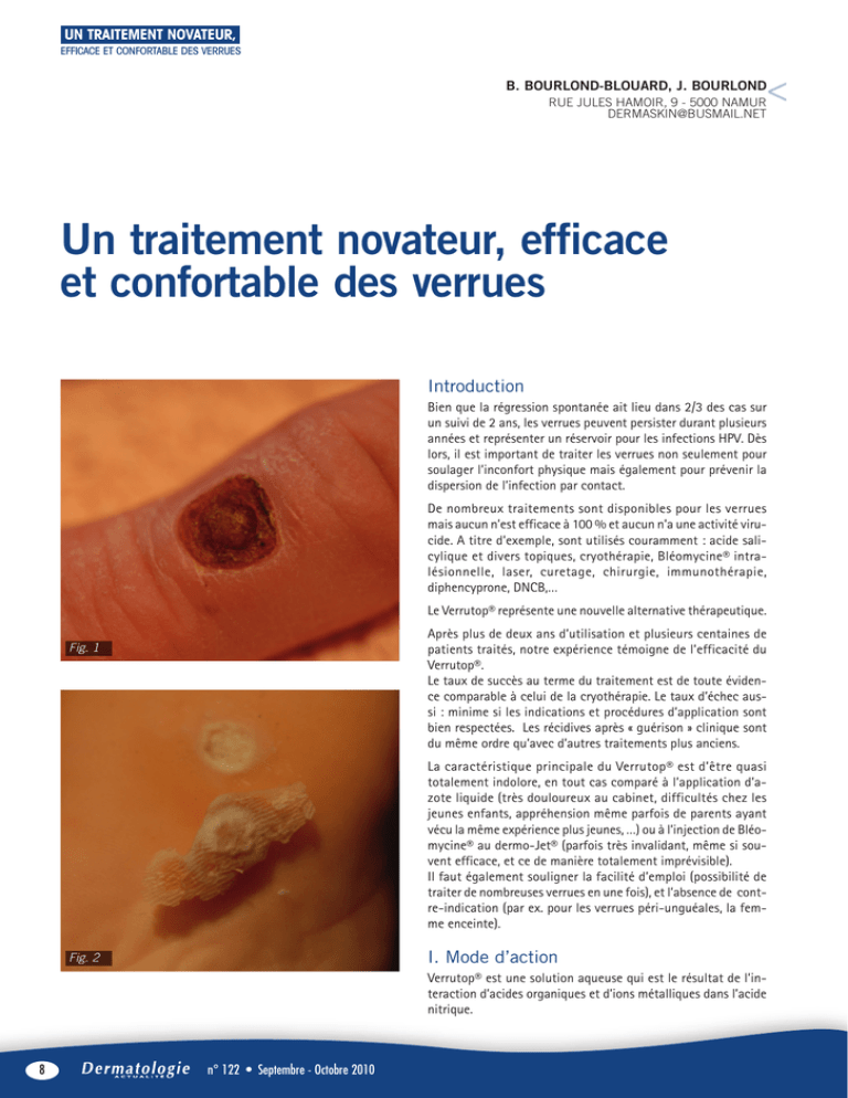 Un Traitement Novateur Efficace Et Confortable Des Verrues