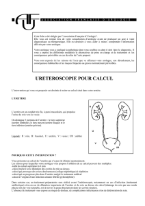 ureteroscopie pour calcul