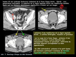 inguinales obliques externes bilatérales