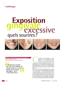 Exposition gingivale excessive