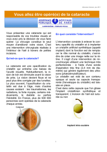 Cataracte - Service d`Ophtalmologie