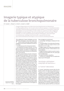 Imagerie typique et atypique de la tuberculose bronchopulmonaire