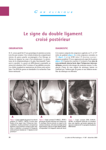 Le signe du double ligament croisé postérieur
