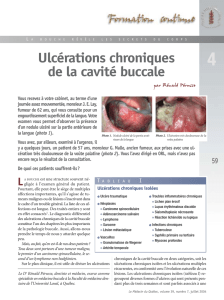 Ulcérations chroniques de la cavité buccale
