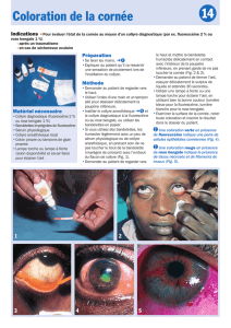 Coloration de la cornée 14 - Community Eye Health Journal