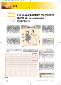 ECG des cardiopathies congénitales