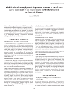 Modifications histologiques de la prostate normale et cancéreuse