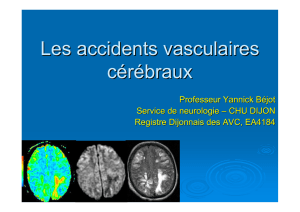 Les accidents vasculaires cerebraux