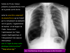 D CC thorax oedème pulmonaire de ré-expansion
