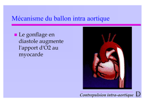 Mécanisme du ballon intra aortique