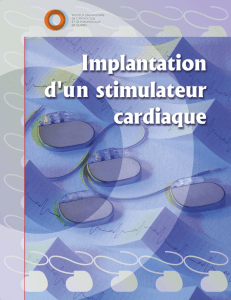 Implantation d`un stimulateur cardiaque