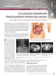 L`occlusion intestinale chez le patient atteint de cancer