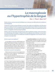 La macroglossie ou l`hypertrophie de la langue