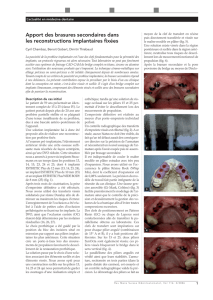 Brasures secondaires en implantologie