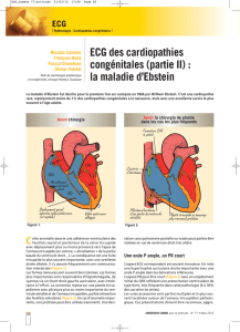 ECG des cardiopathies congénitales (partie II)