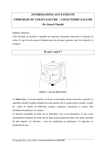 Colectomie gauche - Chirurgie Digestive