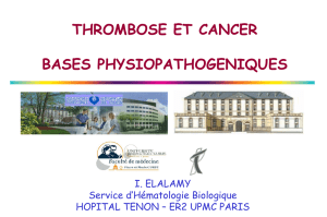 Risque de TVP est - Groupe Francophone thrombose et cancer