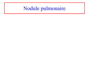 Nodule pulmonaire