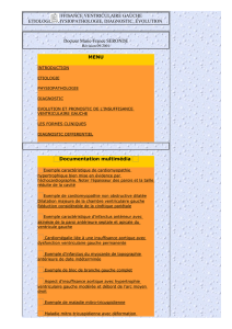 INSUFFISANCE VENTRICULAIRE GAUCHE