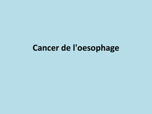 Cancer de l`oesophage