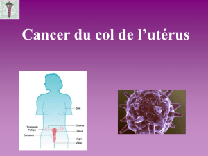 Cancer du col de l`utérus