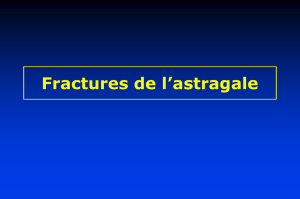 Astragale Fractures
