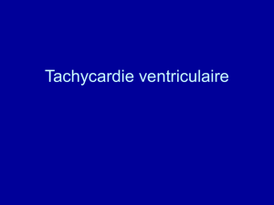 Tachycardie ventriculaire