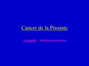 Prise en charge du cancer de la prostate
