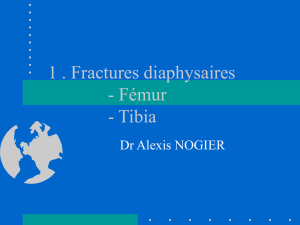 1 . Fractures diaphysaires - Fémur