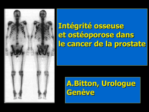 Ostéoporose et cancer de la prostate [PPS]