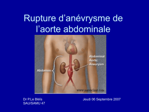 Rupture d`anévrisme de l`aorte abdominale