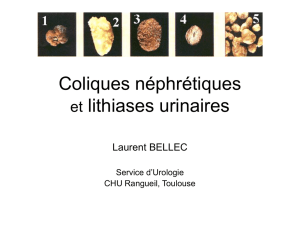 Coliques néphrétiques et lithiases urinaires