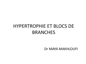 HYPERTROPHIE ET BLOCS DE BRANCHES