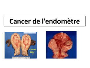 Cancer de l`endomètre