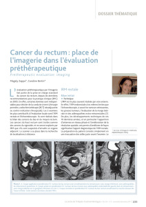 Cancer du rectum : place de l`imagerie dans l`évaluation