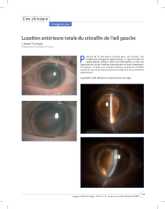 Luxation antérieure totale du cristallin de l`œil gauche