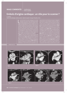Embols d`origine cardiaque : un rôle pour le scanner ?