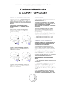 L`ostéotomie Mandibulaire de DALPONT - OBWEGESER