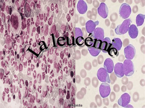 La leucémie