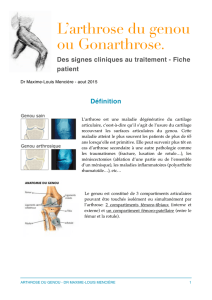 arthrose du genou - Orthopedie Amiens Docteur Menciere Chirurgien