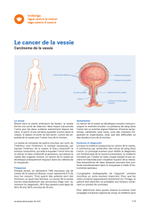 Le cancer de la vessie - Carcinome de la vessie
