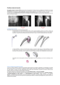 Prothèse totale de hanche - Clinique Emilie de Vialar