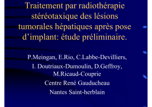 Traitement par radiothérapie stéréotaxique des lésions tumorales