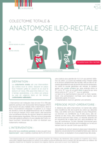 Colectomie totale et Anastomose iléo-rectale