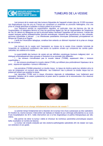 Cancer de la vessie - Groupe Hospitalier Diaconesses Croix Saint